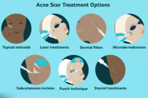 acne-scar-treatment