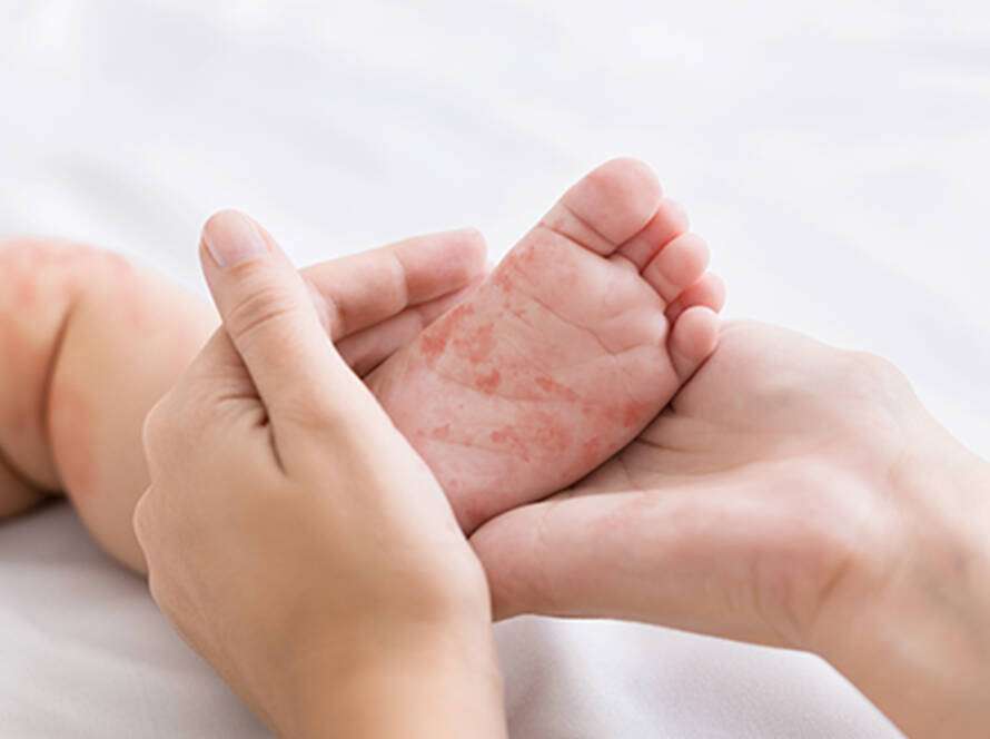 Paediatric Dermatology