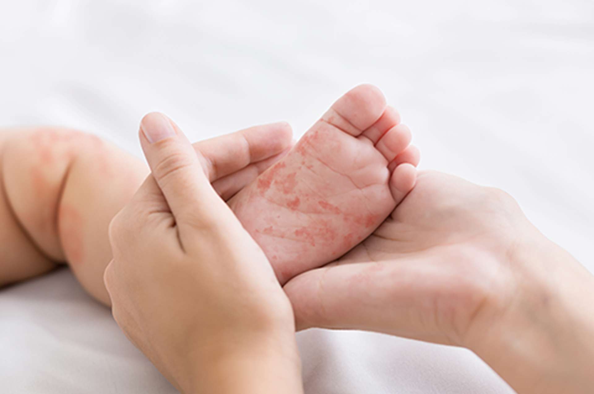 Paediatric Dermatology