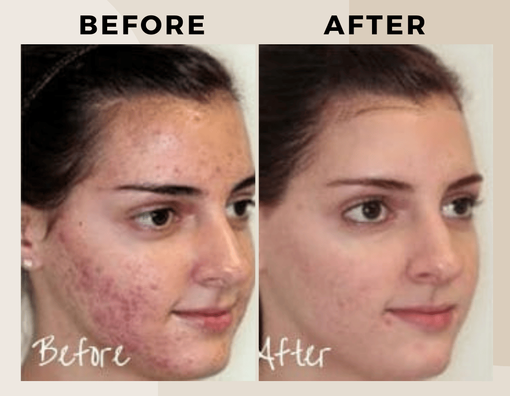 Microdermabrasion Skin Treatment-ritus-skin-care