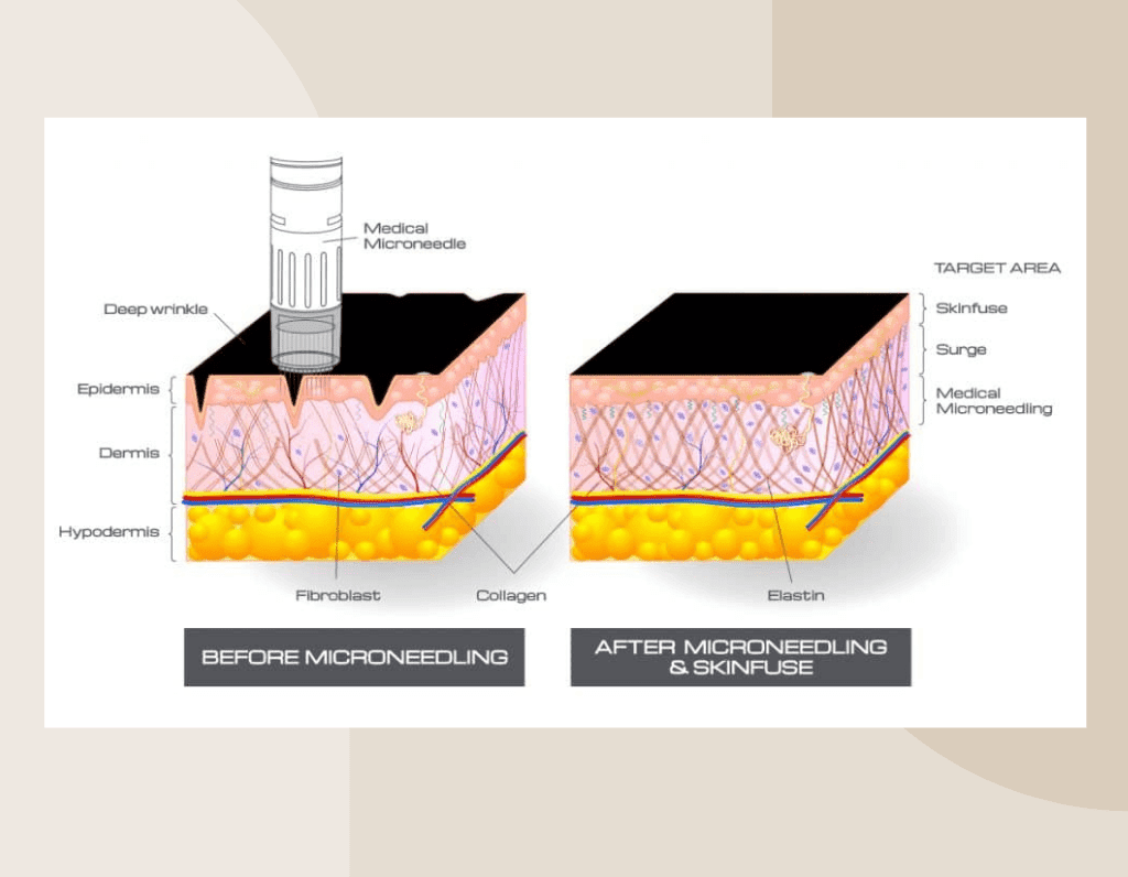 Microneedling - Skinlab Deal-ritus-skin-care