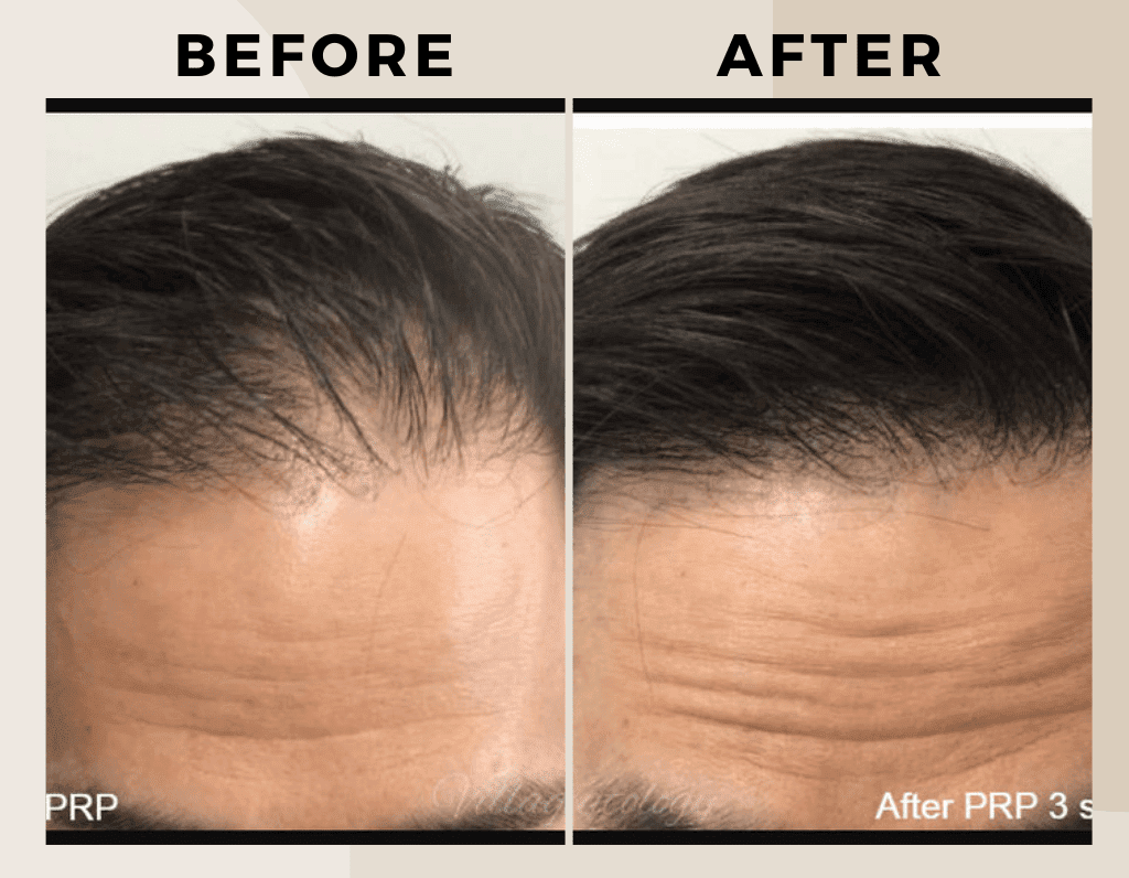 PRP Therapy-Before-after-ritus-hair-skin-care