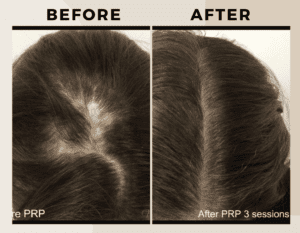PRP Therapy-Before-after-ritus-hair-skin-care-3