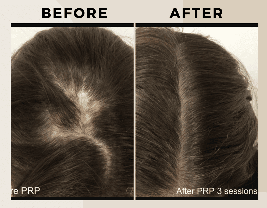 PRP Therapy-Before-after-ritus-hair-skin-care