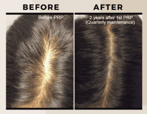 PRP Therapy-Before-after-ritus-hair-skin-care