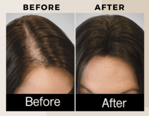 PRP Therapy-Before-after-ritus-hair-skin-care-4