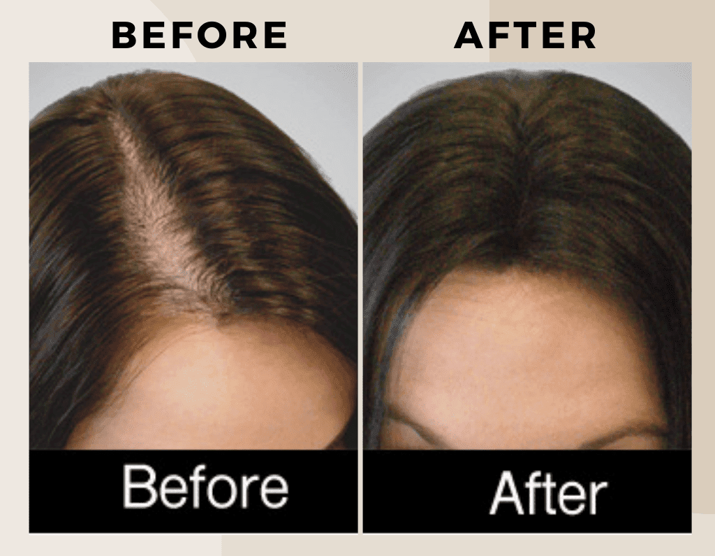 PRP Therapy-Before-after-ritus-hair-skin-care