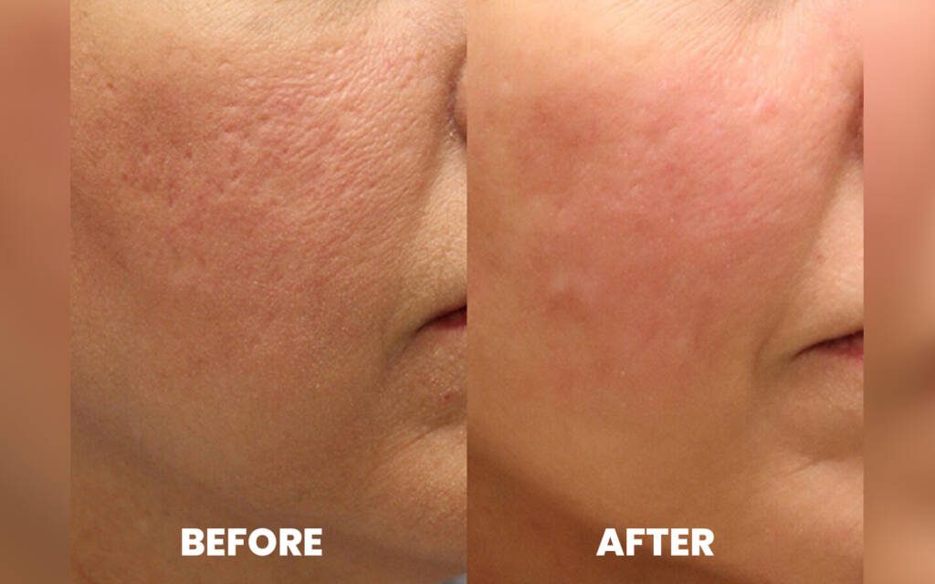 Ritus-before-after-micro-needling-ritus-skin-clinic