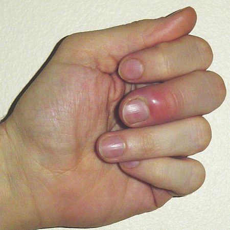 INFLAMMATION OF THE SKIN ALONGSIDE THE NAIL-PARONYCHIA ​